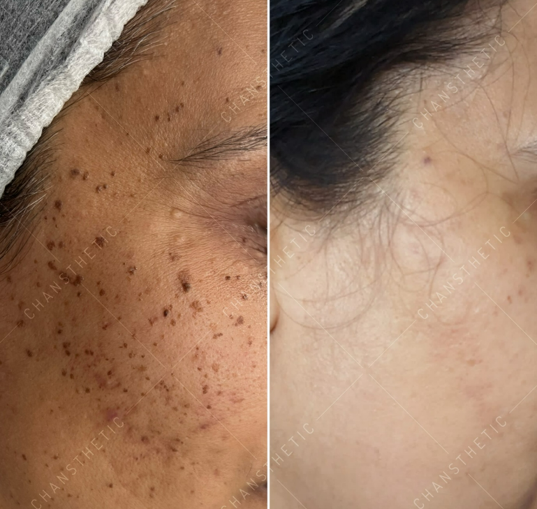 Spot clearance — before & after