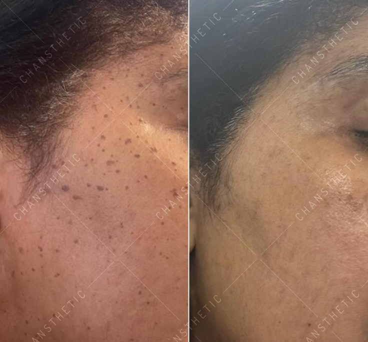 Even skin tone — before & after