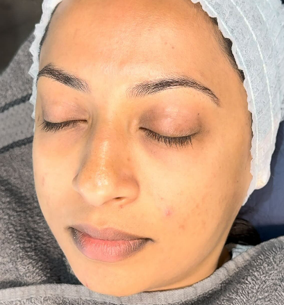 Facial treatment close-up