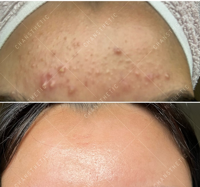 Congested skin clearance — before & after
