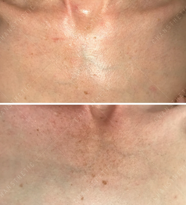 Pigmentation balance — before & after