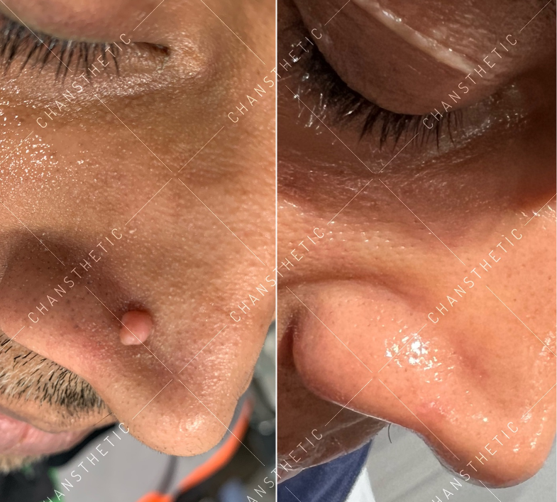 Skin tag removal — before & after
