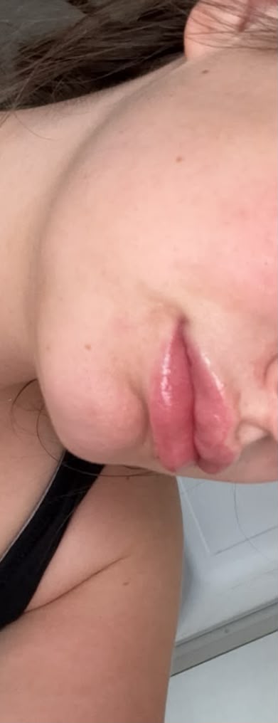Lip filler 1.1ml
