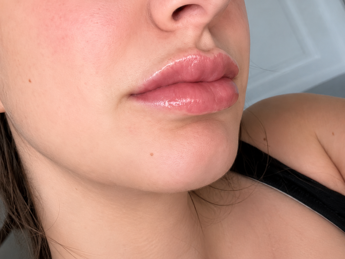 Lip filler 1.1ml