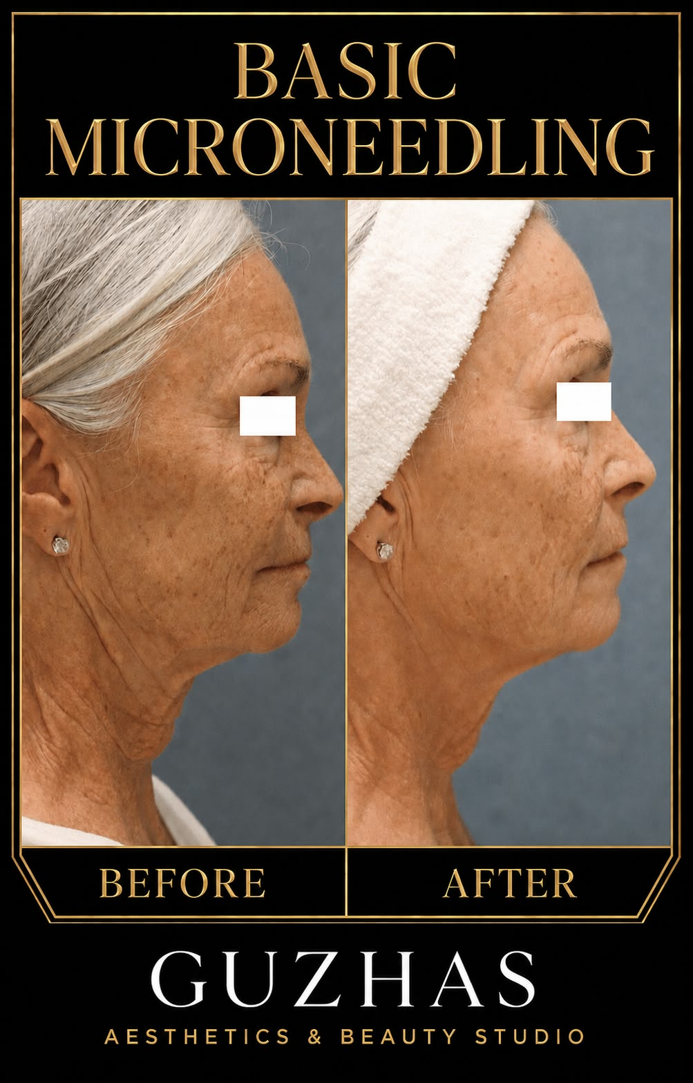 Microneedling basic